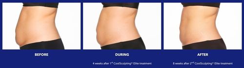 Before, during, after CoolSculpting treatment progress.