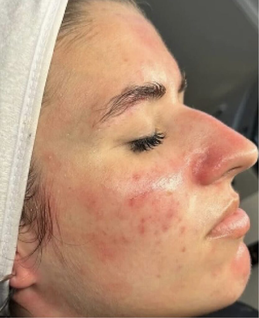 Close-up of facial redness and acne.