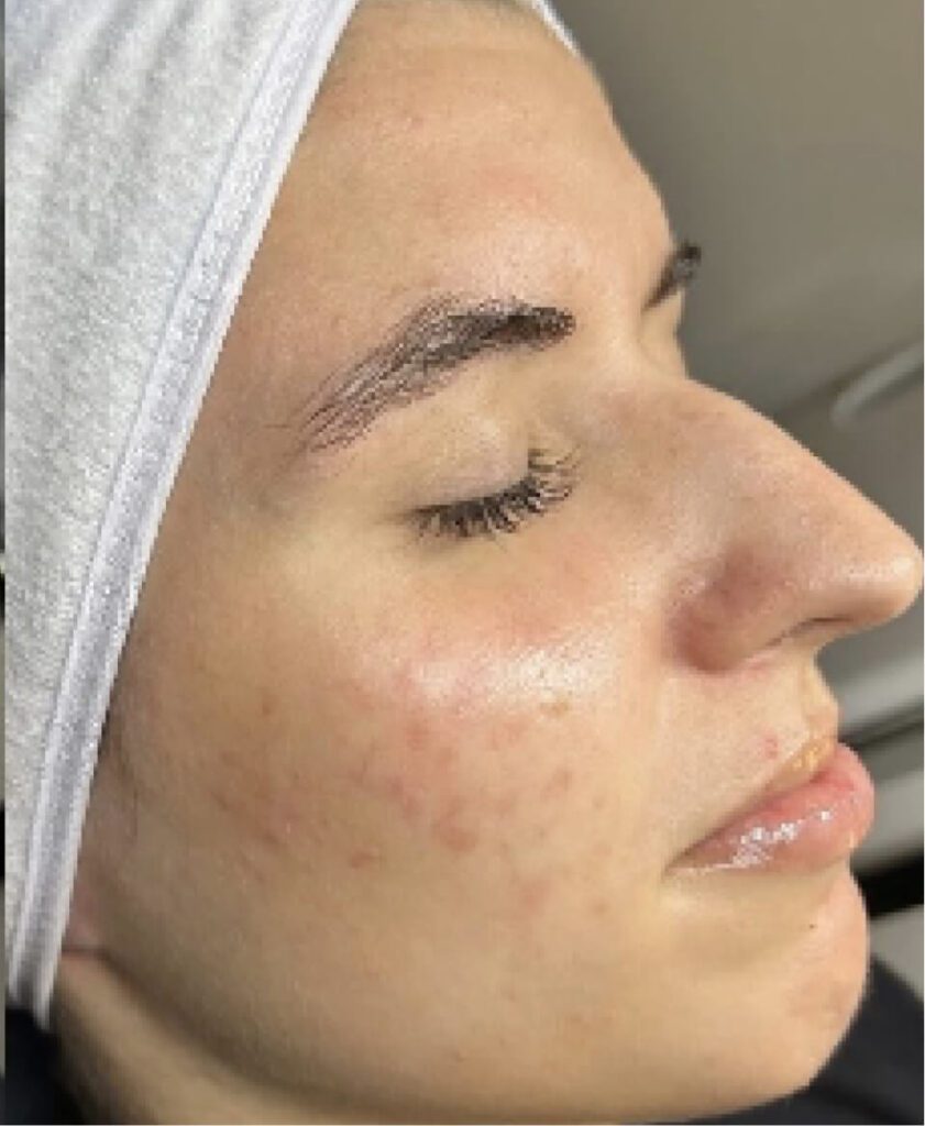 Woman with acne and fair skin close-up