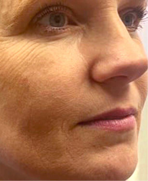 Close-up of a woman's face with wrinkles.