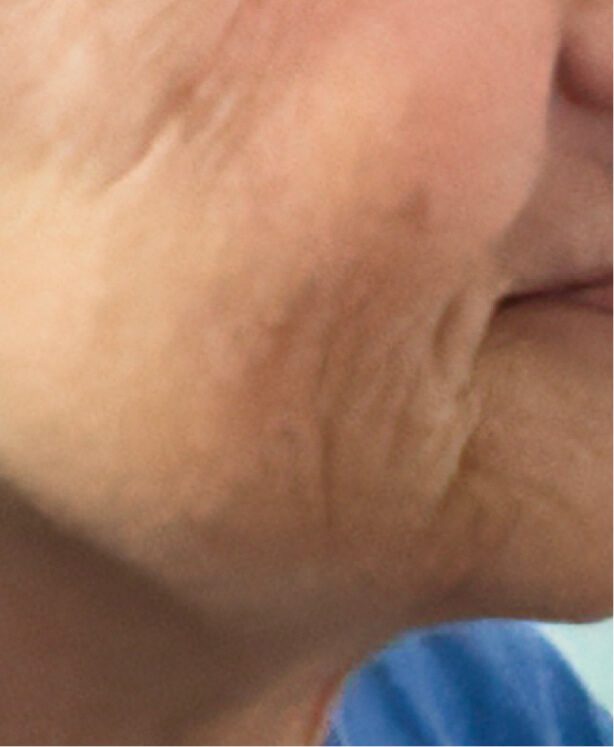 Close-up of wrinkled cheek and chin