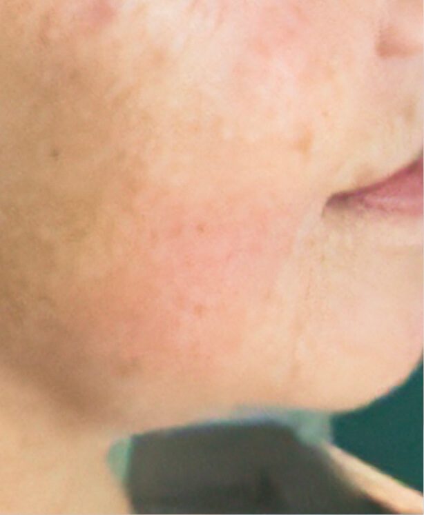 Close-up of skin with acne scarring.