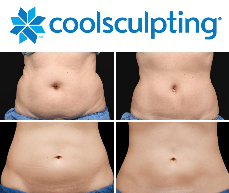 CoolSculpting before and after treatment results.